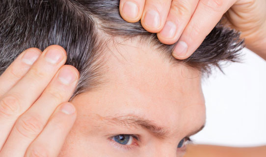 La mésotherapie des cheveux - Traitement Calvitie